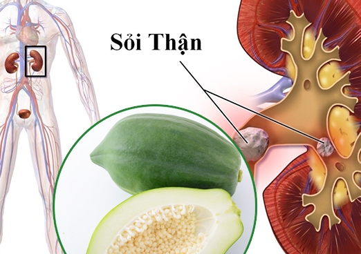 Bài thuốc dân gian chữa bệnh sỏi thận
